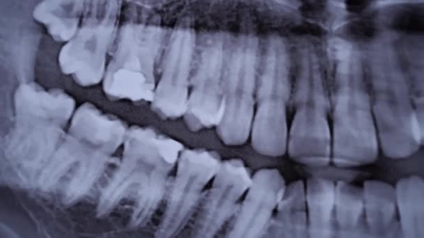 Ray Image Jaw All Human Teeth Close Magnetic Resonance Imaging — Stockvideo