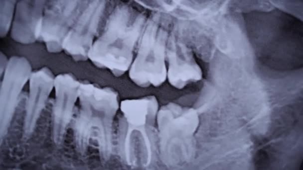 Ray Image Jaw All Human Teeth Close Magnetic Resonance Imaging — Stock video