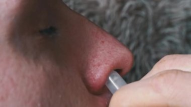 Adam kırmızı burnuna özel bir sprey sıkar. Hasta bir insan burnunun akmasından muzdarip. Viral enfeksiyon. Sağlık hizmetleri. Ev tedavisi.