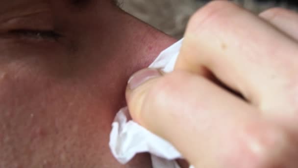 一个红鼻子的男人把他的鼻子吹进了一张白色的餐巾纸里 一个病人流鼻涕 病毒感染 家庭治疗 — 图库视频影像