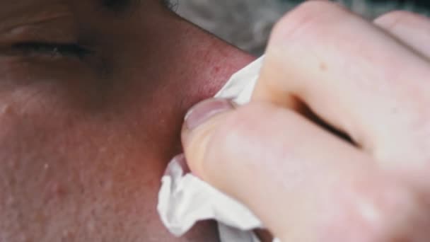 Человек Красным Носом Высморкался Белую Салфетку Крупным Планом Больной Страдает — стоковое видео
