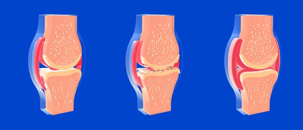 Ilustrace Synoviálních Kloubů Dalších Kloubů Osteoartritidou Revmatoidní Artritidou Grafické Znázornění — Stock fotografie