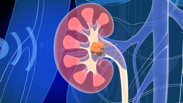 Anatomical Animation Interior Kidney Showing Kidney Stones Action Disintegrating Them — Stock Video