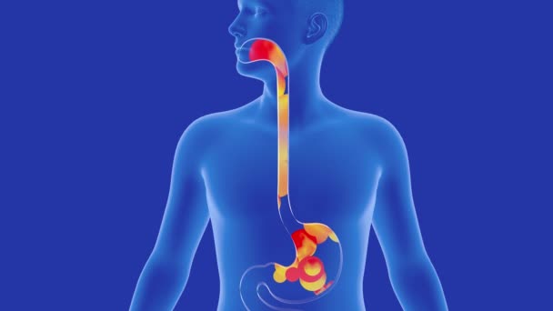 胃和食管的解剖三维动画 有回流口 带着热情和火圈蓝色背景下的消化系统和透明的人形 — 图库视频影像