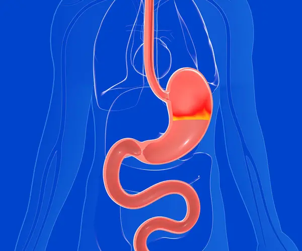 Anatomisk Illustration Magen Med Halsbränna Och Reflux Genomskinlig Människokropp Sedd Stockbild