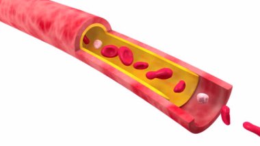 Arterin anatomik 3 boyutlu animasyonu ve biriken yağ nedeniyle tıkanma hareketi. Kan dolaşımındaki kırmızı kan hücrelerini yavaşlatır. Beyaz arkaplanda kılcal damar kesildi.