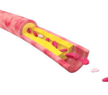 Arterin anatomik üç boyutlu çizimi ve biriken yağ nedeniyle tıkanma hareketi. Kan dolaşımındaki kırmızı kan hücrelerini yavaşlatır. Beyaz arkaplanda kılcal damar kesildi.