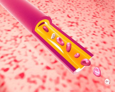 Anatomical 3D illustration of artery capillary with fat obstruction. Movement of red blood cells and platelets in blood circulation. Cutout capillary on organic background. clipart