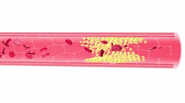 Beceriksiz bir arterin iç kısmının anatomik 3 boyutlu animasyonu. Birikmiş olan yağ tıkanıklığından dolayı. Kırmızı kan hücreleri ve trombosit dolaşımı kesintiye uğramış. Beyaz arkaplanda kılcal damar