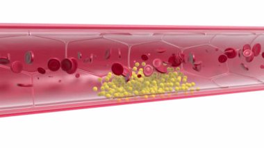 Kırmızı kan hücrelerinin hareketleriyle bir arterin iç kısmının anatomik 3 boyutlu animasyonu. Yağ neredeyse arterin içini tıkayana kadar birikir. Normal kan dolaşımı bozuluyor..