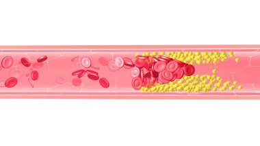 Yağ birikimi yüzünden tıkanmış bir arterin iç kısmının anatomik üç boyutlu çizimi. Kırmızı kan hücreleri normal kan dolaşımını engelleyen bir tıpa oluşturur..