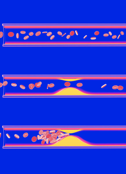 3D illustration of the interior of a transparent glass artery. Obstructed by the accumulation of fat (cholesterol). Movement of red blood cells and platelets in an interrupted blood circulation. Capillary on blue background.
