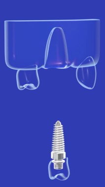 Karışık, gerçekçi ve şeffaf grafik tarzında bir diş implantının 3 boyutlu animasyonu. İki aşamada, yerleştirmeden önce ve sonra. Mavi arka plandaki cam sakıza yerleştirilmiş, iç mekanı gösteriyor..
