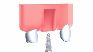 Gerçekçi ve anatomik grafik tarzda bir diş implantının 3 boyutlu animasyonu. İki aşamada, yerleştirmeden önce ve sonra. Beyaz arka planda üst sakıza yerleştirilmiş, iç mekanı gösteriyor..