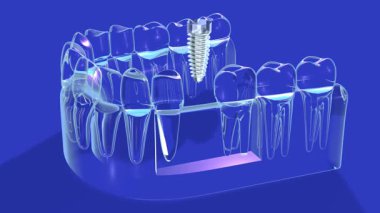 Şeffaf cam grafikli bir diş implantının 3 boyutlu animasyonu. Mavi arka planda anatomik sakıza yerleştirilen implantı gösteriyor..