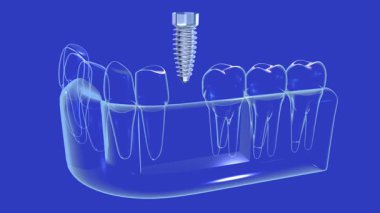 Şeffaf cam grafikli bir diş implantının 3 boyutlu animasyonu. Mavi arka planda anatomik sakıza yerleştirilen implantı gösteriyor..