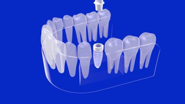 Beyaz, şeffaf ve anatomik grafik tarzda bir diş implantının 3 boyutlu animasyonu. Yerleştirmeden önce ve sonra implantı gösteriyor. Mavi arkaplandaki cam sakıza yerleştirilmiş, yukarıdan görülüyor..