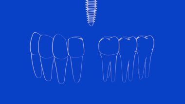 Şeffaf cam grafikli bir diş implantının 3 boyutlu animasyonu. Mavi arka planda anatomik sakıza yerleştirilen implantı gösteriyor..