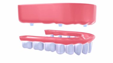 Dişçi protezinin 3 boyutlu animasyonu gerçekçi bir grafik tarzında. Diş implantlarıyla bir sakıza yerleştirme eylemini gösteriyor, sonra da döndürülüyor. Beyaz bir arkaplanda.