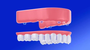 Dişçi protezinin gerçekçi bir grafik tarzında 3 boyutlu çizimi. Diş implantlı bir sakıza yerleştirilmeden önce ve sonra. Döndürmek için. Mavi bir arkaplanda, aşağıdan izleniyor.