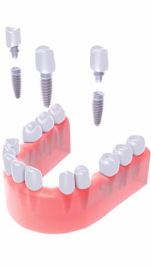 Bir sakıza aynı anda yerleştirilen üç diş implantının dikey 3D animasyonu. Gerçekçi bir anatomik grafik tarzı var. Yukarıdan bakıldığında beyaz arkaplan.