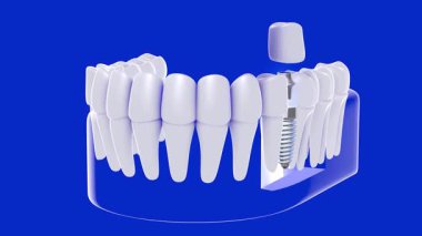 Beyaz ve şeffaf grafik tarzda bir diş implantının 3 boyutlu animasyonu. İmplantın yerleştirilmeden önce ayrıldığını gösteriyor. Mavi arka plandaki cam sakıza yerleştirilmiş, anatomik iç mekanı gösteriyor..