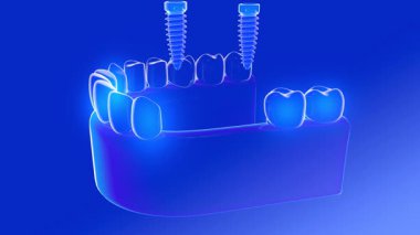 Şeffaf cam bir sakıza yerleştirilen çift implantın 3 boyutlu animasyonu. Üç dişli implant. Şeffaf iç mekanı ışıklarla gösteriyor. Mavi bir arkaplanda.