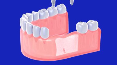 Çift implantın 3 boyutlu animasyonu gerçekçi bir şekilde sakıza yerleştiriliyor. Üç dişli implant. Sakız ve kemiğin bir kısmının içini gösteriyor. Mavi bir arkaplanda.