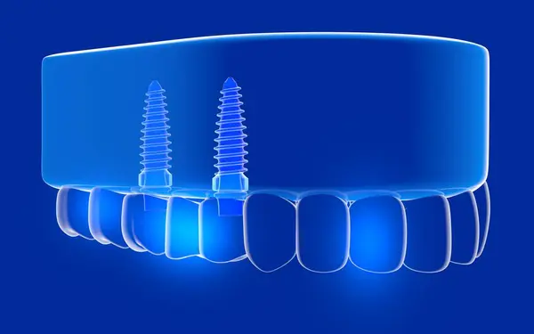 Şeffaf cam bir sakıza yerleştirilmiş çift implantın 3 boyutlu çizimi. Üç dişli implant. Şeffaf iç mekanı ışıklarla gösteriyor. Mavi bir arkaplanda.
