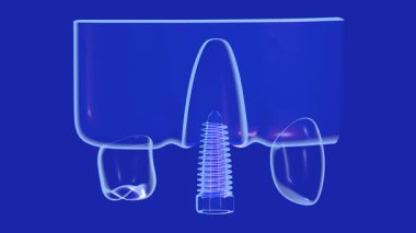 Şeffaf ve anatomik grafik tarzda vidalı bir diş implantının 3 boyutlu animasyonu. Dahili ışıkla. Mavi arka plandaki cam sakıza yerleştirilmiş, iç mekanı gösteriyor..