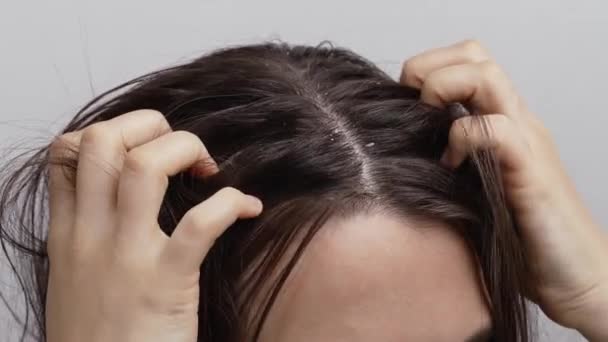 Woman Scratching Itchy Scalp White Background — Stock Video