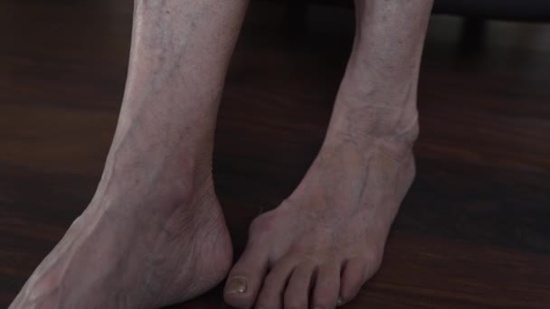 老年血栓形成妇女的腿 — 图库视频影像