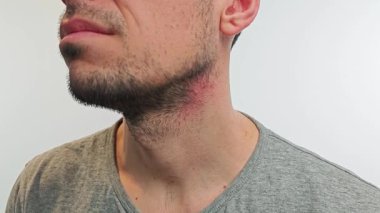 Bir erkek parmaklarıyla iltihaplı, kırmızı boynunu tırmalayarak alerji, sürtünme ya da strese bağlı kaşıntıdan kaynaklanan deri tahrişini vurgular..