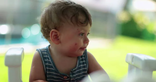 Adorable baby toddler outside in backyard during summer day. Infant face covered with mosquito bites