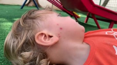 Baby infant mosquito bites on face after scratching. Child bruises due to scratch itching.