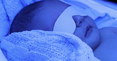 Newborn baby boy under phototherapy lamp. getting treated for jaundice