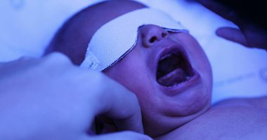 Newborn baby boy getting treated for jaundice under a phototherapy lamp