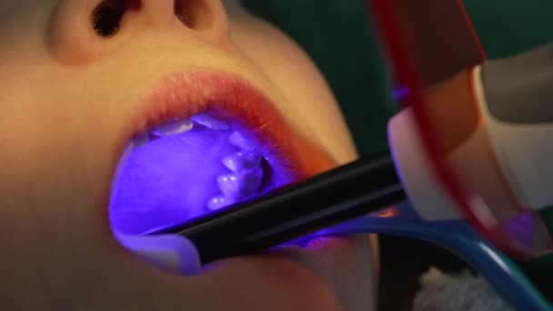 Tandläkare Använda Photopolymerizer Barnets Tänder Närbild Tandvård — Stockvideo
