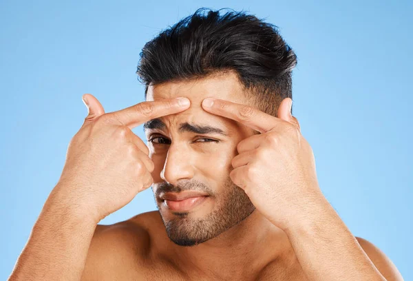 Cuidados Com Pele Confuso Retrato Homem Acne Com Mãos Rosto — Fotografia de Stock