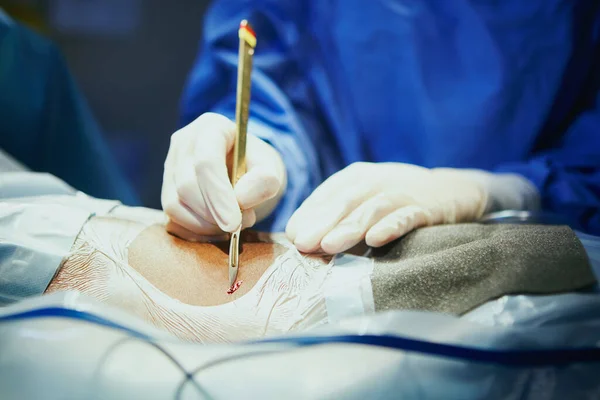 做完美的切口 手术室里的外科医生 — 图库照片