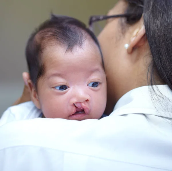 Medische Gespleten Lip Een Kinderarts Met Een Baby Het Ziekenhuis — Stockfoto