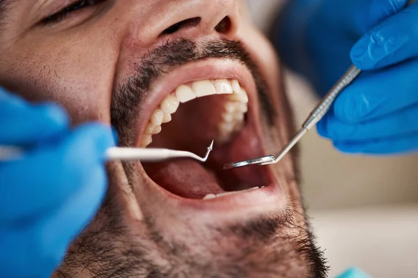 男性和有牙科 医疗保健或门诊部工具的牙医的手 口腔健康 牙齿矫正和有医生 镜子和挖掘机的病人 用于清洁牙齿和医疗卫生 — 图库照片