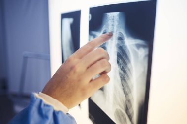 Hastanede bir ekranda sağlık teşhisi için röntgen analizi yapan tıbbi, el ve doktor. Profesyonel, kariyer ve kadın radyolog sağlık ocağında omurga, akciğer ve göğüs taramasını kontrol ediyor.