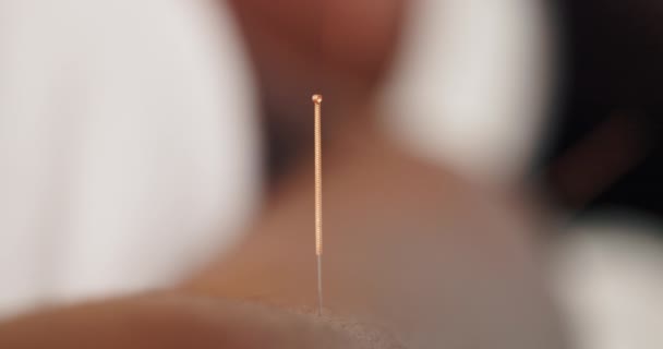 Traitement Par Gros Plan Aiguille Acupuncture Pour Santé Bien Être — Video