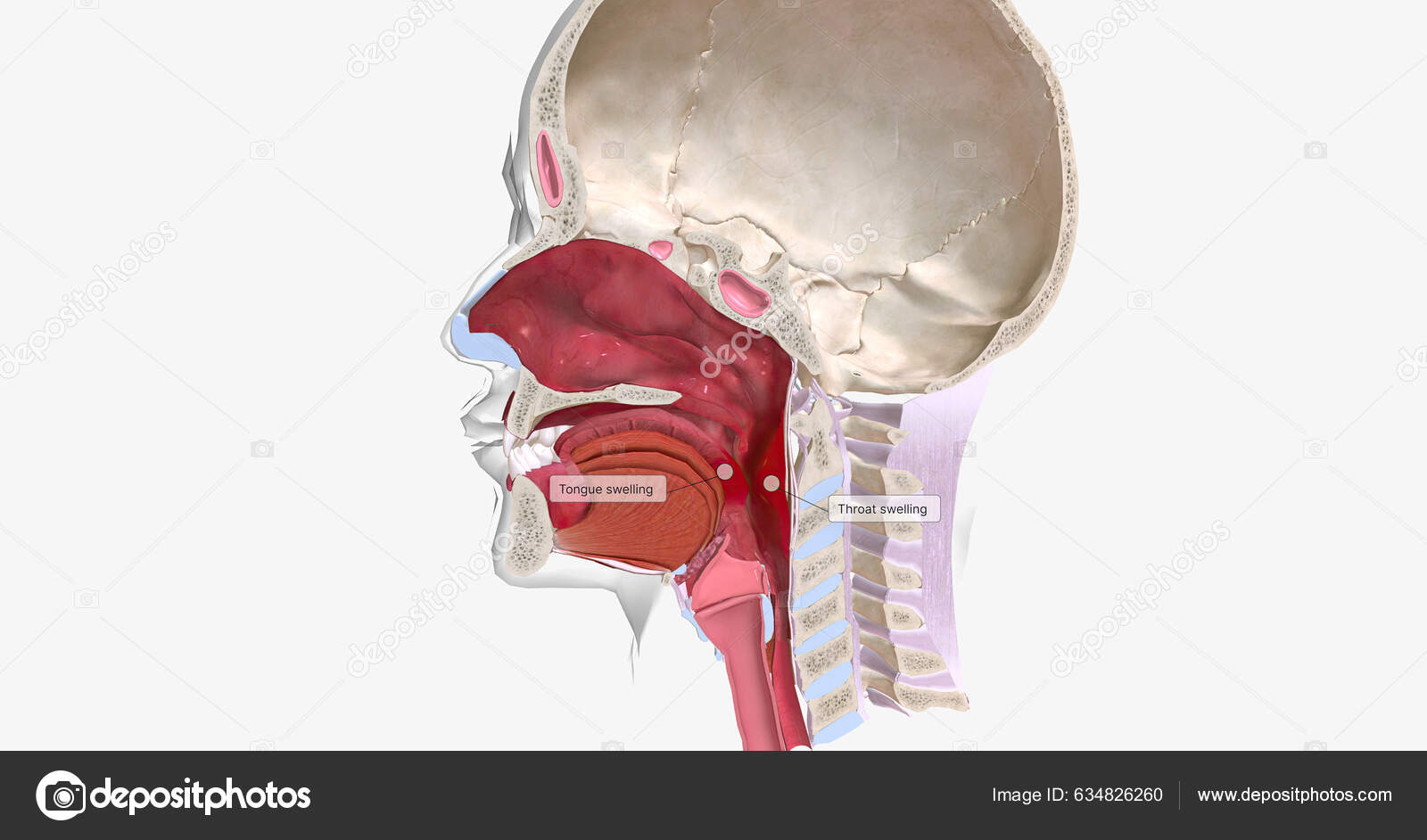 Anaphylaxis Severe Systemic Allergic Reaction Characterized Swelling ...