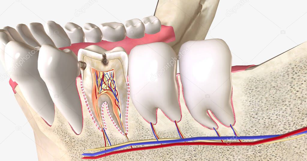 Dental caries, or cavities, are areas of tooth decay caused by acid