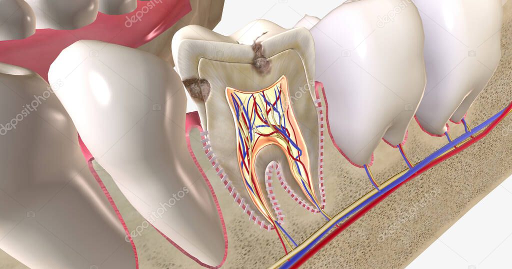 Dental caries, or cavities, are areas of tooth decay caused by acid
