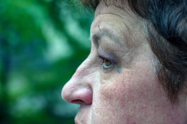 Büyük mor bir morluğu olan bir insan gözü. Çürüğe bağlı şişkinlik..