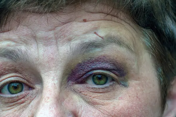 大きな黒紫色の傷を持つ人間の目 ブルーズによる腫れ — ストック写真