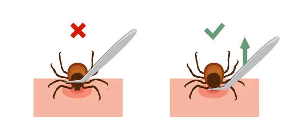 Manera Correcta Quitar Garrapata Piel Después Picar Insecto Correctamente Ilustración — Vector de stock